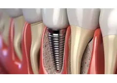 Dental Implants in Geneva