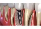 Dental Implants in Geneva