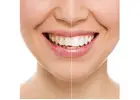 Achieve a Brighter Smile with Teeth Whitening Melbourne CBD